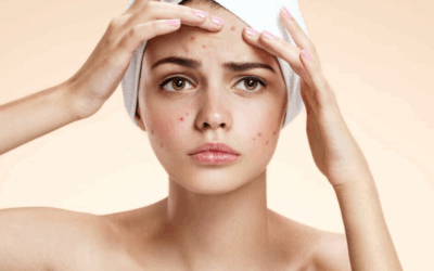 ACNE: wat is het en waarom heb ik het?