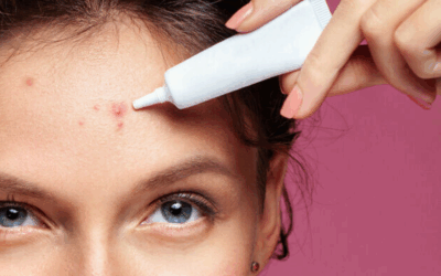 Acne bestrijd je zo!